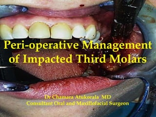 Peri-operative Management
of Impacted Third Molars
Dr Chamara Atukorala MD
Consultant Oral and Maxillofacial Surgeon
 