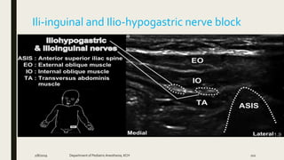 Ili-inguinal and Ilio-hypogastric nerve block
2/8/2019 Department of PediatricAnesthesia, KCH 102
 