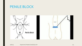 PENILE BLOCK
2/8/2019 Department of PediatricAnesthesia, KCH 104
 