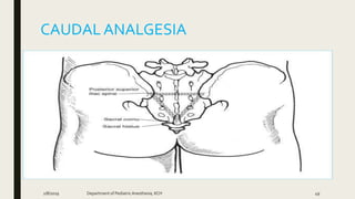 CAUDALANALGESIA
2/8/2019 Department of PediatricAnesthesia, KCH 49
 