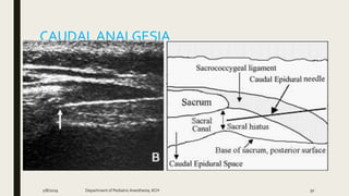 CAUDAL ANALGESIA
2/8/2019 Department of PediatricAnesthesia, KCH 50
 