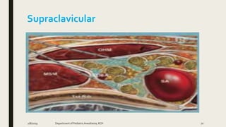 Supraclavicular
2/8/2019 Department of PediatricAnesthesia, KCH 70
 