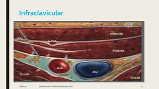Infraclavicular
2/8/2019 Department of PediatricAnesthesia, KCH 72
 