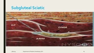 Subgluteal Sciatic
2/8/2019 Department of PediatricAnesthesia, KCH 81
 