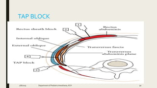 TAP BLOCK
2/8/2019 Department of PediatricAnesthesia, KCH 90
 