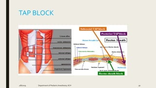 TAP BLOCK
2/8/2019 Department of PediatricAnesthesia, KCH 91
 