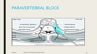 PARAVERTEBRAL BLOCK
2/8/2019 Department of PediatricAnesthesia, KCH 95
 