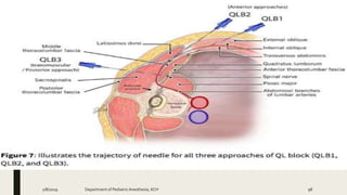 QL BLOCK
2/8/2019 Department of PediatricAnesthesia, KCH 98
 