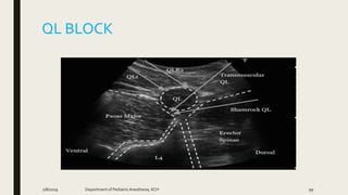 QL BLOCK
2/8/2019 Department of PediatricAnesthesia, KCH 99
 
