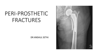 PERI-PROSTHETIC
FRACTURES
DR ANSHUL SETHI
 