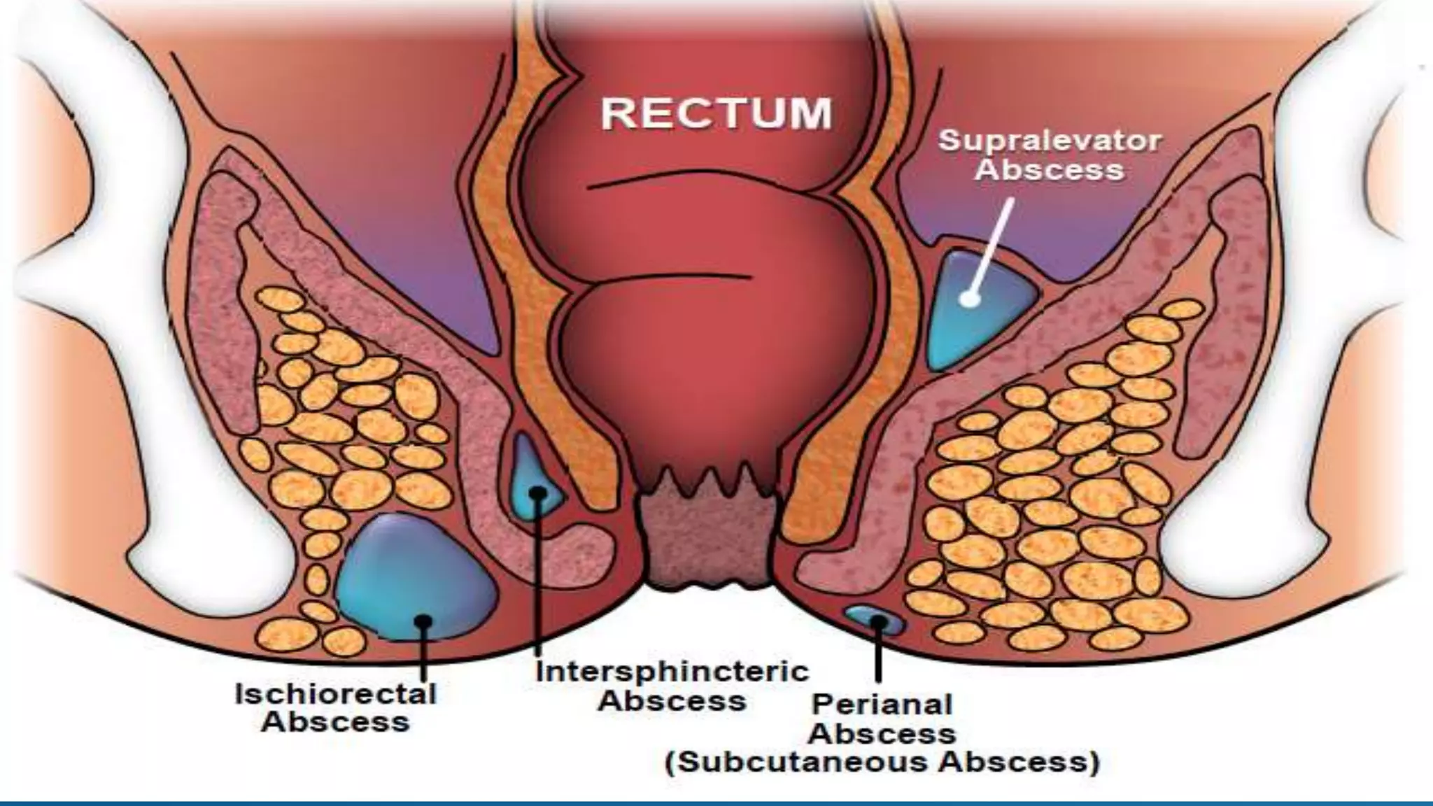 PERIANAL ABSCESS.pptx