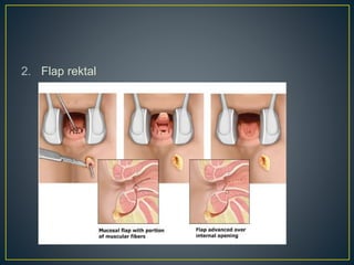2. Flap rektal
 
