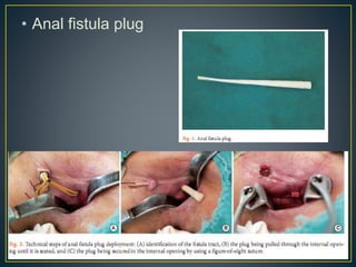 • Anal fistula plug
 