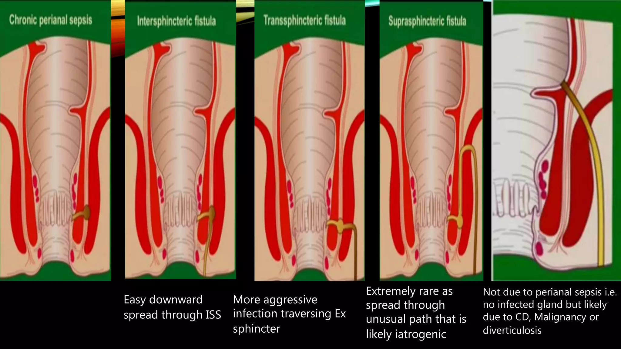 perianal-fistula-pptx
