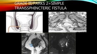Parks Classification Perianal fistula | PPTX
