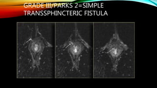 Parks Classification Perianal fistula | PPTX