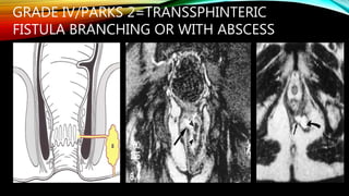 Parks Classification Perianal fistula | PPTX