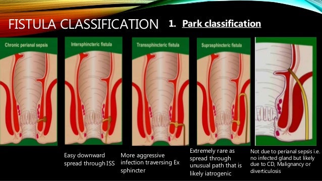 Perianal fistula