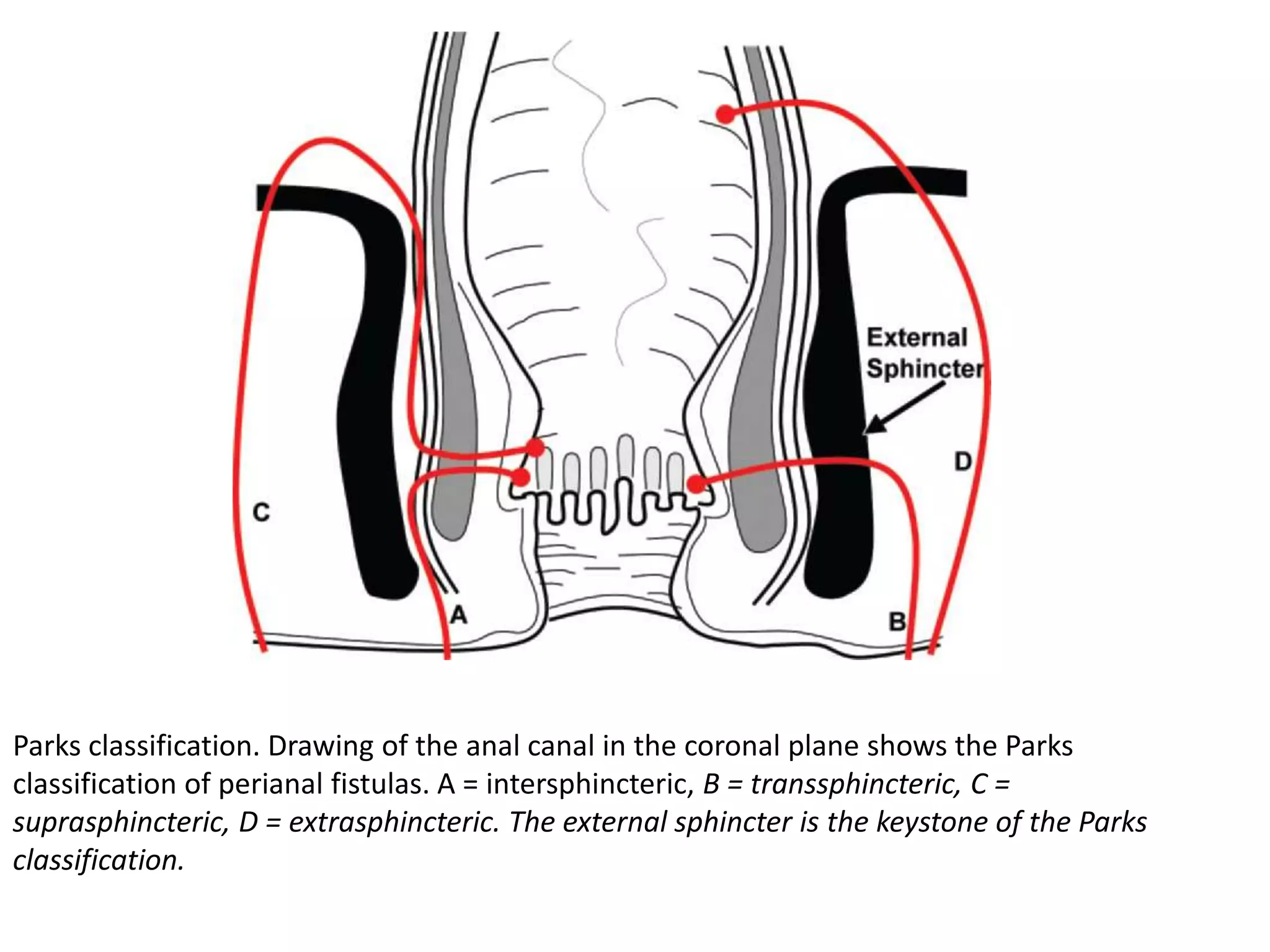 Peri Anal Fistula Mri PPTX peri-anal-fistula-mri-pptx