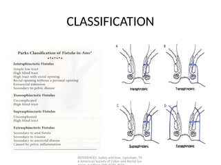 SURGICAL MANAGEMENT OF PERI- ANAL ABCESSES AND INFECTIONS | PPTX