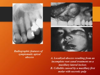 Apical Abscess Rct Periapical diseases and classification | PPTX