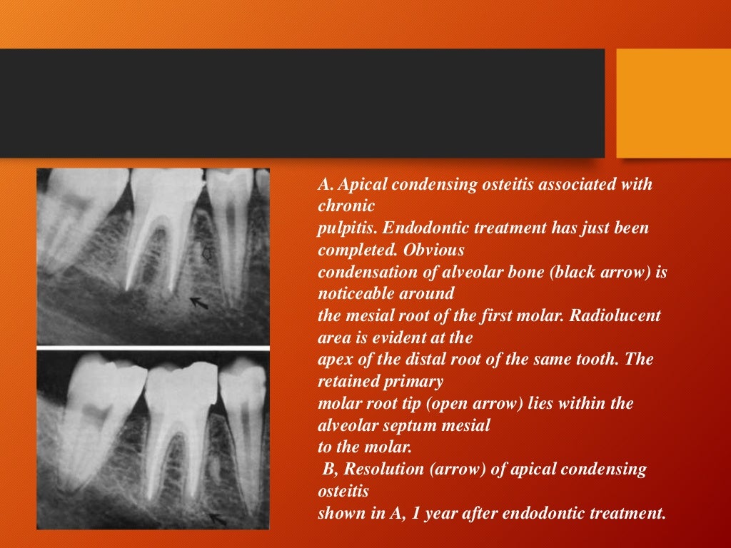 Periapical diseases and classification