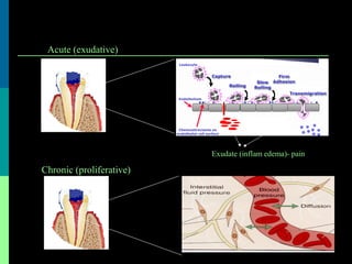 Exudate (inflam edema)- pain
Acute (exudative)
Chronic (proliferative)
 