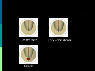 Abscess
Healthy tooth Early apical change
 