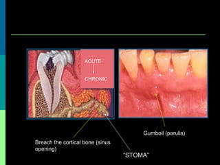 Gumboil (parulis)
Breach the cortical bone (sinus
opening)
“STOMA”
ACUTE
CHRONIC
 