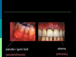 parulis / gum boil
(acute/chronic)
stoma
(chronic)
 