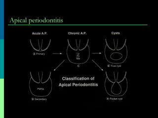 Apical periodontitis
 
