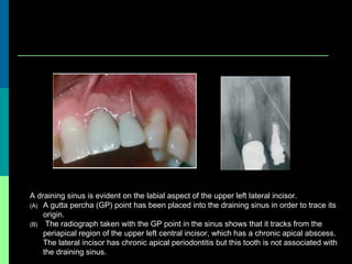 A draining sinus is evident on the labial aspect of the upper left lateral incisor.
(A) A gutta percha (GP) point has been placed into the draining sinus in order to trace its
origin.
(B) The radiograph taken with the GP point in the sinus shows that it tracks from the
periapical region of the upper left central incisor, which has a chronic apical abscess.
The lateral incisor has chronic apical periodontitis but this tooth is not associated with
the draining sinus.
 