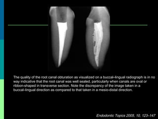 The quality of the root canal obturation as visualized on a buccal–lingual radiograph is in no
way indicative that the root canal was well sealed, particularly when canals are oval or
ribbon-shaped in transverse section. Note the discrepancy of the image taken in a
buccal–lingual direction as compared to that taken in a mesio-distal direction.
Endodontic Topics 2005, 10, 123–147
 