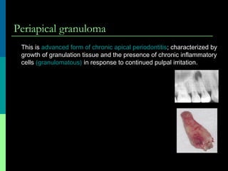 Periapical granuloma
This is advanced form of chronic apical periodontitis; characterized by
growth of granulation tissue and the presence of chronic inflammatory
cells (granulomatous) in response to continued pulpal irritation.
 