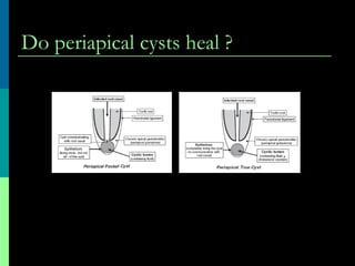 Do periapical cysts heal ?
 