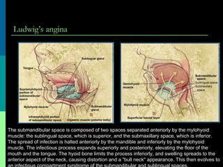 Ludwig’s angina
The submandibular space is composed of two spaces separated anteriorly by the mylohyoid
muscle: the sublingual space, which is superior, and the submaxillary space, which is inferior.
The spread of infection is halted anteriorly by the mandible and inferiorly by the mylohyoid
muscle. The infectious process expands superiorly and posteriorly, elevating the floor of the
mouth and the tongue. The hyoid bone limits the process inferiorly, and swelling spreads to the
anterior aspect of the neck, causing distortion and a "bull neck" appearance. This then evolves to
 