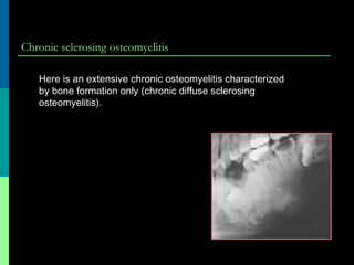 Chronic sclerosing osteomyelitis
Here is an extensive chronic osteomyelitis characterized
by bone formation only (chronic diffuse sclerosing
osteomyelitis).
 