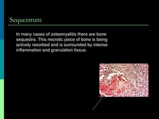 Sequestrum
In many cases of osteomyelitis there are bone
sequestra. This necrotic piece of bone is being
actively resorbed and is surrounded by intense
inflammation and granulation tissue.
 