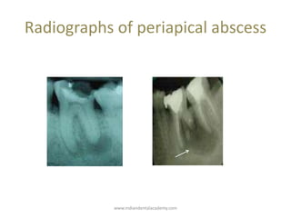 Radiographs of periapical abscess
www.indiandentalacademy.com
 