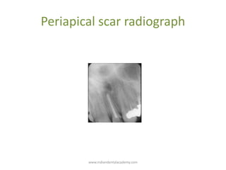 Periapical scar radiograph
www.indiandentalacademy.com
 