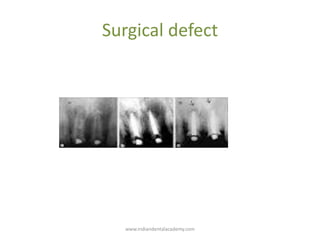 Surgical defect
www.indiandentalacademy.com
 