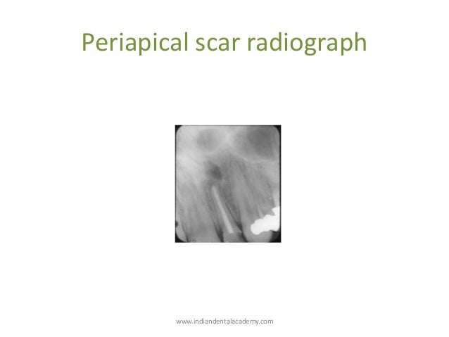 apical scar barca fontanacountryinn com apical scar