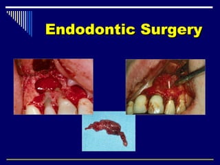 Endodontic SurgeryEndodontic Surgery
 