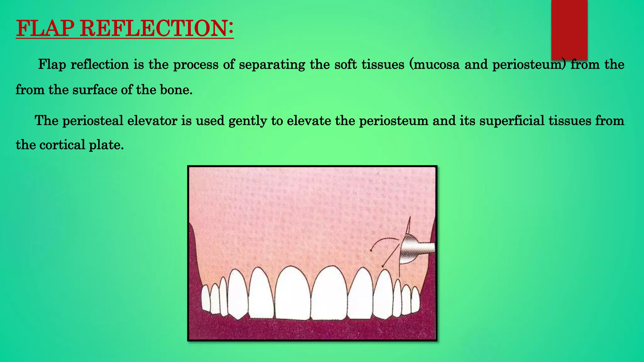 FLAP REFLECTION:
Flap reflection is the process of separating the soft tissues (mucosa and periosteum) from the
from the surface of the bone.
The periosteal elevator is used gently to elevate the periosteum and its superficial tissues from
the cortical plate.
 