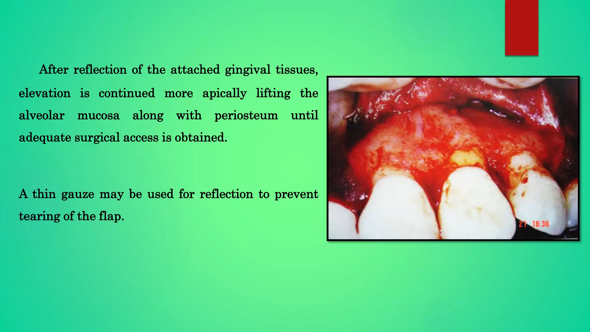 After reflection of the attached gingival tissues,
elevation is continued more apically lifting the
alveolar mucosa along with periosteum until
adequate surgical access is obtained.
A thin gauze may be used for reflection to prevent
tearing of the flap.
 