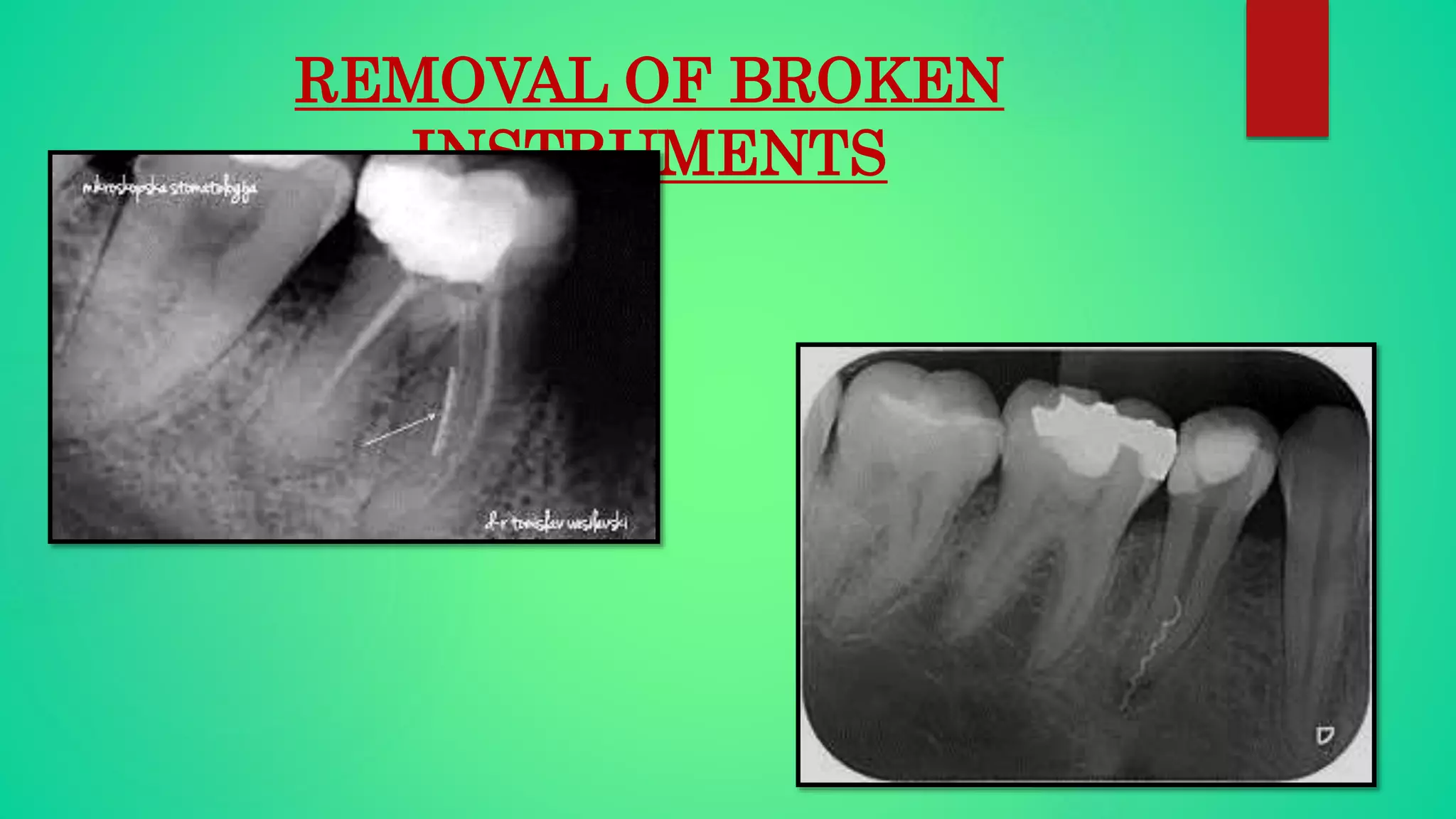 REMOVAL OF BROKEN
INSTRUMENTS
 