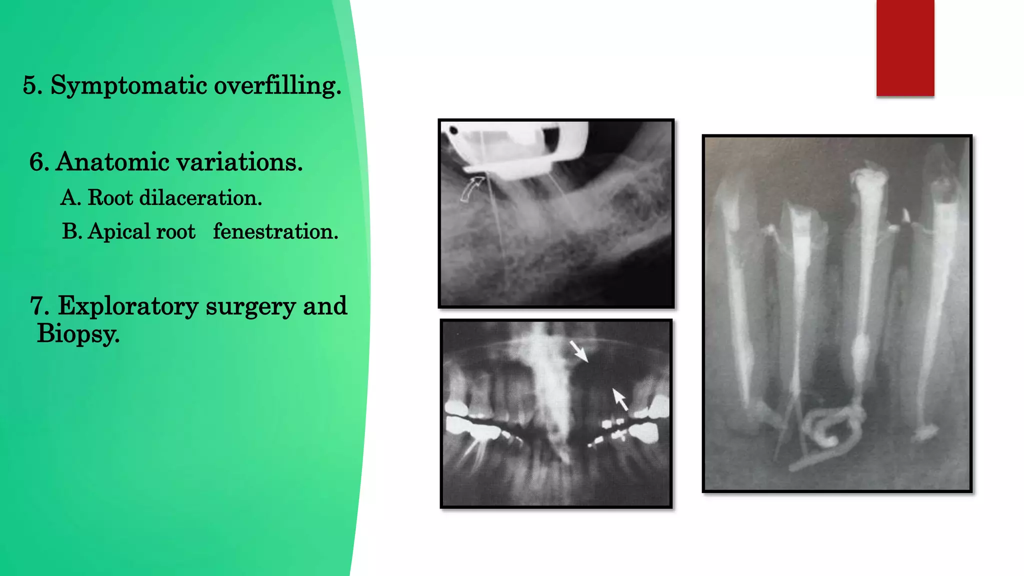 5. Symptomatic overfilling.
6. Anatomic variations.
A. Root dilaceration.
B. Apical root fenestration.
7. Exploratory surgery and
Biopsy.
 