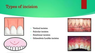 Oval Incision Periapical surgery viji | PPTX