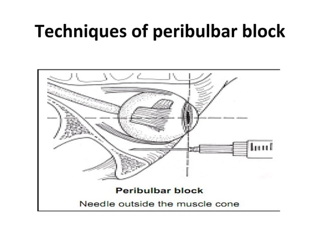 Peribulbar anaesthesia in eye surgery (4) | PPT | Eye and Vision ...