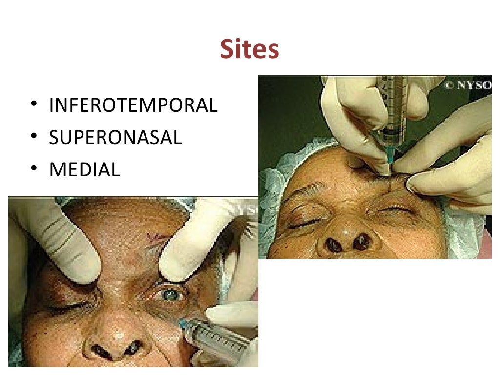 Peribulbar anaesthesia in eye surgery (4)